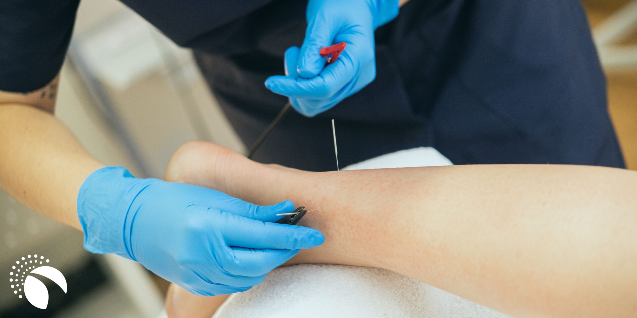 What to Expect from a Dry Needling Session Proactive Rehabilitation